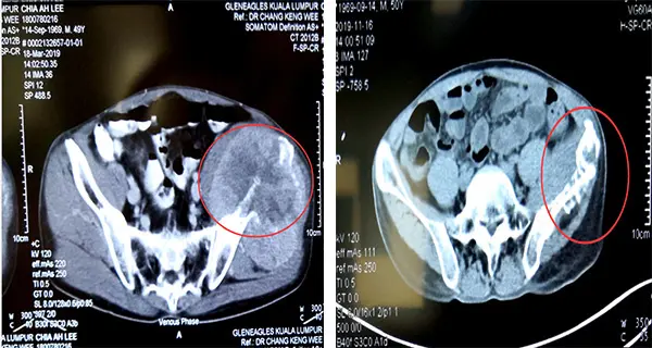 Pasien dengan tumor kambuh