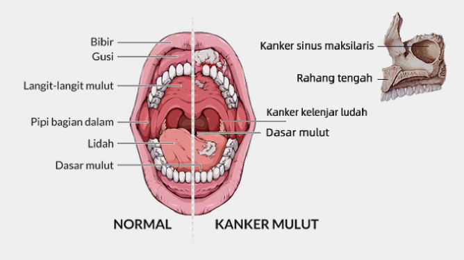 kanker lidah, gusi, langit-langit mulut, kanker rahang tengah, kanker dasar mulut, kanker orofaring, kanker bibir, kanker kelenjar ludah dan kanker sinus maksilaris, serta kanker yang terjadi pada kulit wajah dan selaput lendir