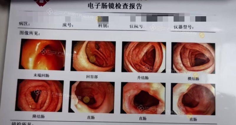 直肠肿瘤明显缩小（治疗后）.jpg
