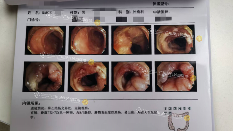 雷迪克肠镜（治疗前）.png